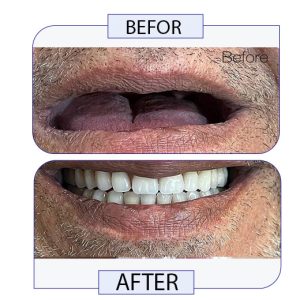 بهترین روش جایگزینی دندان از دست رفته چیست؟