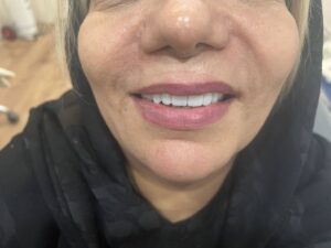 بهترین مارک و نوع دندان مصنوعی ایرانی و خارجی [ ایتالیایی, ژاپنی, آلمانی ]