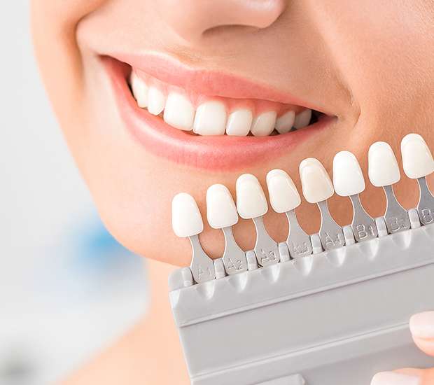 لمینت یا کامپوزیت؟ بررسی کامل تفاوت‌ها، مزایا و قیمت‌ها