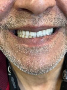 بهترین مارک و نوع دندان مصنوعی ایرانی و خارجی [ ایتالیایی, ژاپنی, آلمانی ]