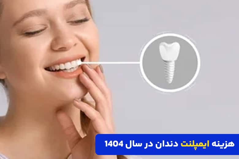 هزینه انواع ایمپلنت دندان در سال ۱۴۰۴ در تهران