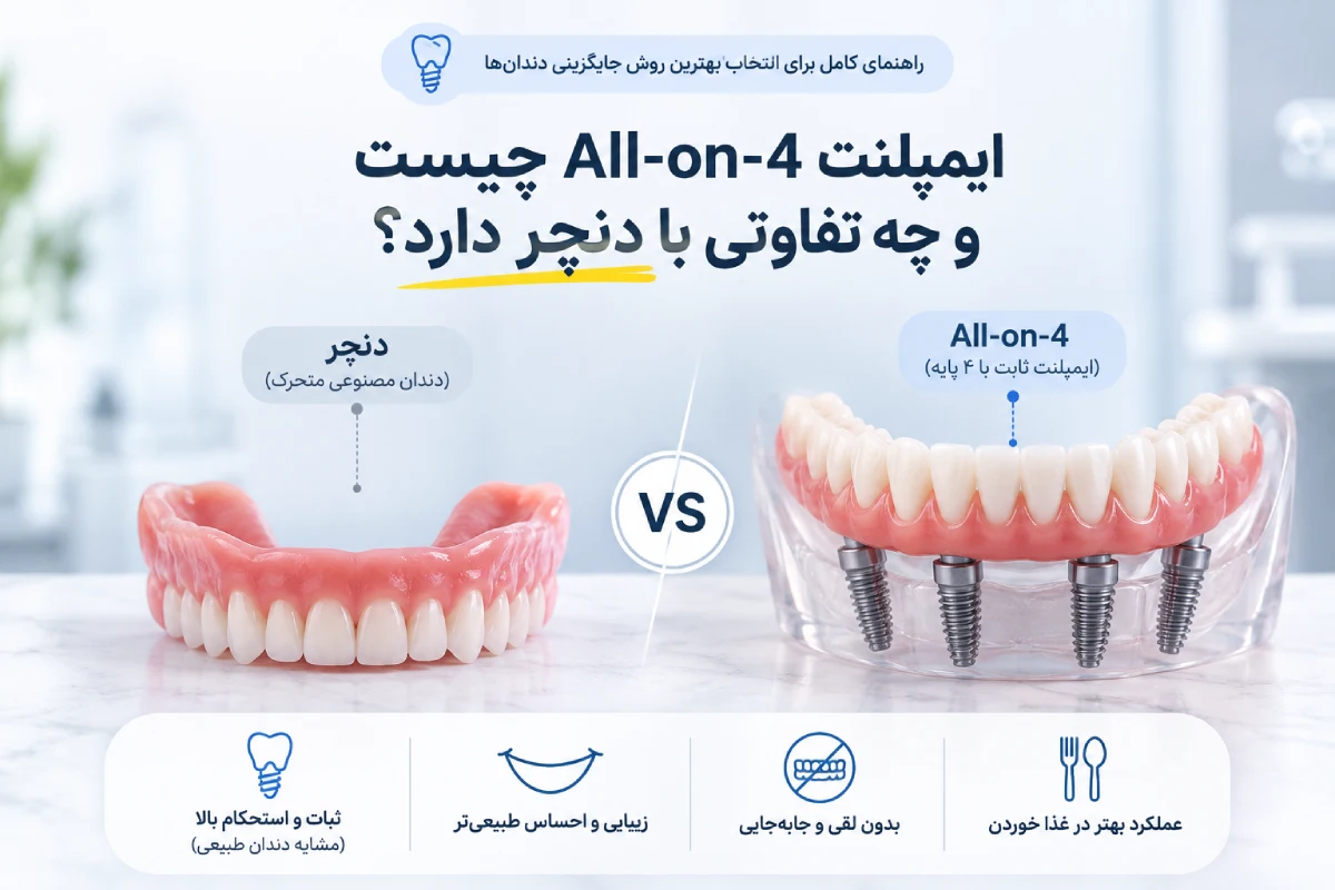 ایمپلنت All-on-4 چیست و چه تفاوتی با دنچر دارد؟