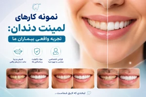 نمونه کار از مراجعین لمینت دندان