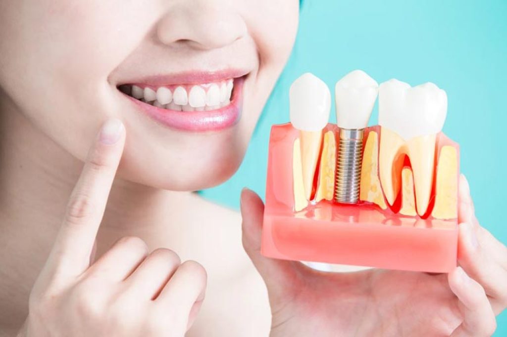 ایمپلنت دندان چیست؟ انواع ایمپلنت دندان